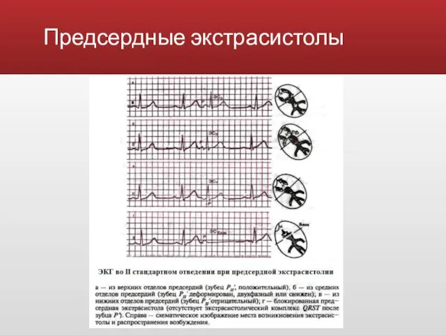 Предсердные экстрасистолы