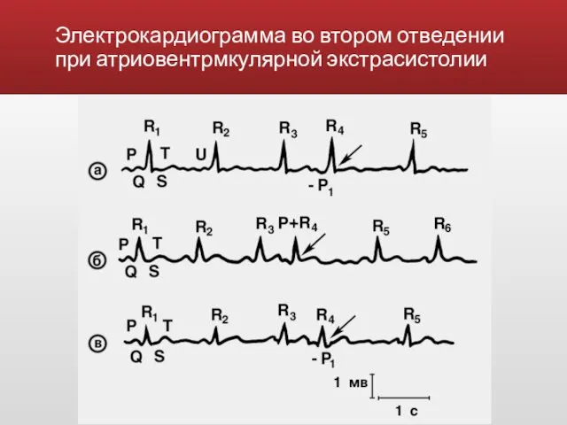 Электрокардиограмма во втором отведении при атриовентрмкулярной экстрасистолии