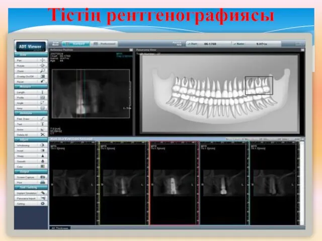 Тістің рентгенографиясы