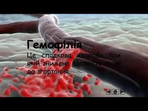 Гемофілія Це спадкова хвороба при якій знижена здатність крові до згортання.