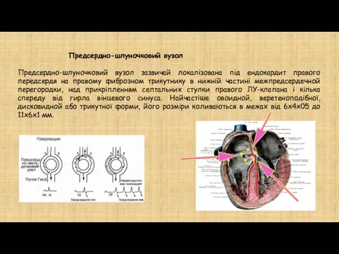 Предсердно-шлуночковий вузол Предсердно-шлуночковий вузол зазвичай локалізована під ендокардит правого передсердя