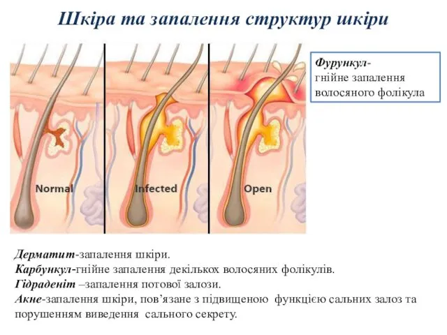 Шкіра та запалення структур шкіри Фурункул- гнійне запалення волосяного фолікула Дерматит-запалення шкіри. Карбункул-гнійне