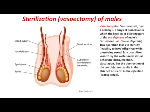 Sterilization (vasoectomy) of males Vasectomy (lat. Vas - a vessel,