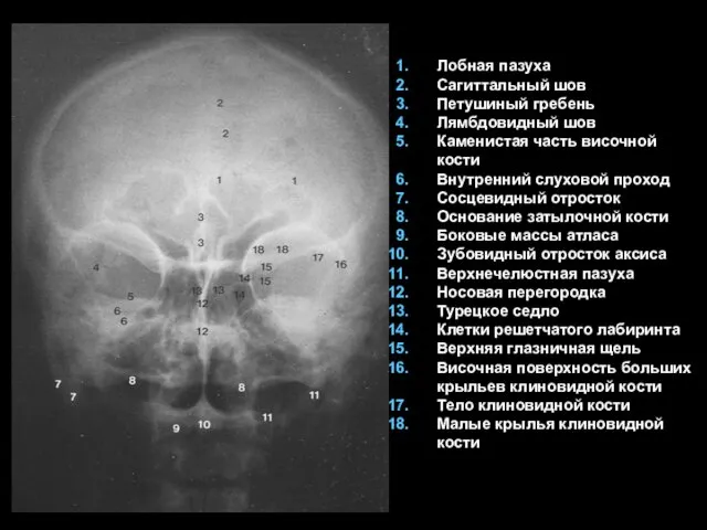 Лобная пазуха Сагиттальный шов Петушиный гребень Лямбдовидный шов Каменистая часть