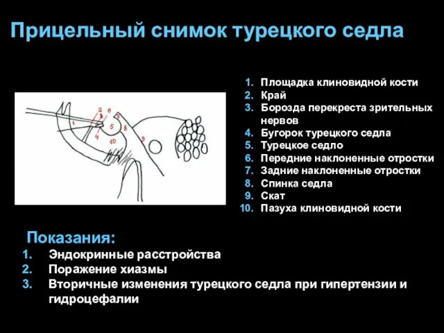 Прицельный снимок турецкого седла Площадка клиновидной кости Край Борозда перекреста