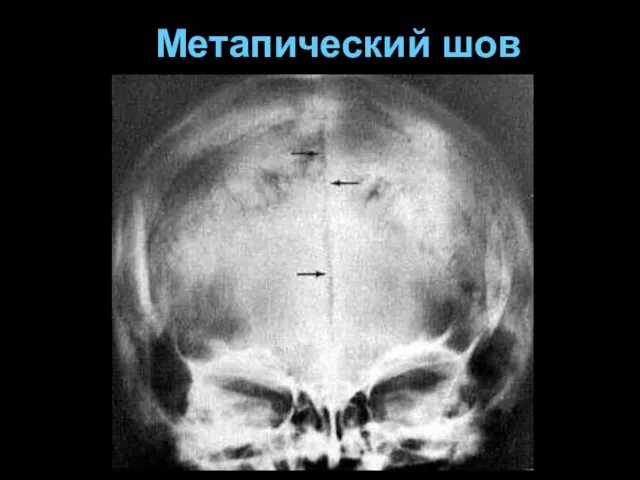 Метапический шов