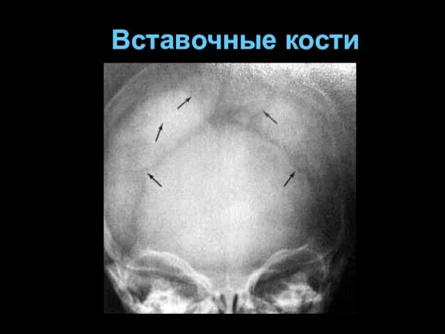 Вставочные кости