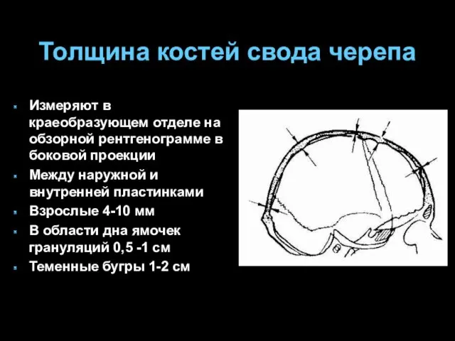 Толщина костей свода черепа Измеряют в краеобразующем отделе на обзорной