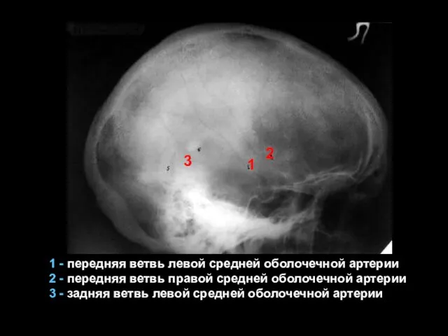 1 - передняя ветвь левой средней оболочечной артерии 2 -