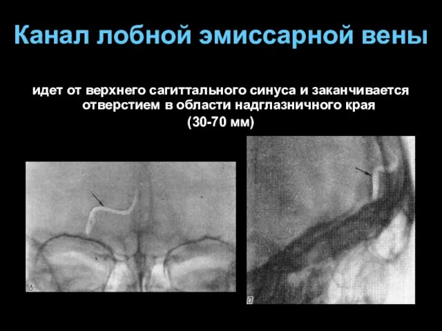 идет от верхнего сагиттального синуса и заканчивается отверстием в области