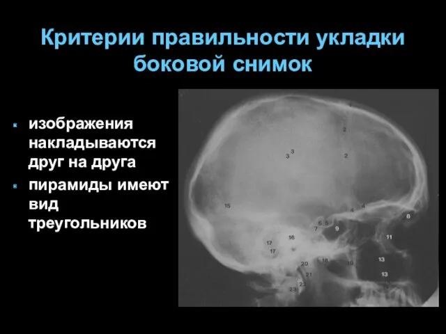 Критерии правильности укладки боковой снимок изображения накладываются друг на друга пирамиды имеют вид треугольников