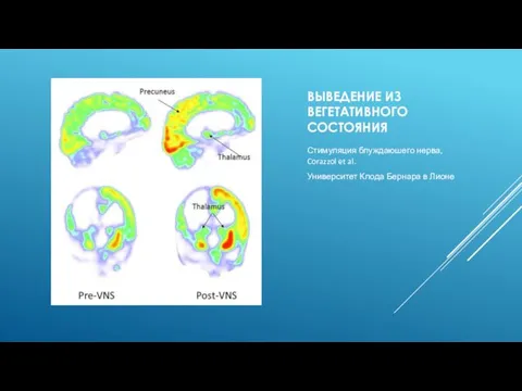 ВЫВЕДЕНИЕ ИЗ ВЕГЕТАТИВНОГО СОСТОЯНИЯ Стимуляция блуждаюшего нерва, Corazzol et al. Университет Клода Бернара в Лионе