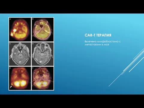 СAR-T ТЕРАПИЯ Вылечена лимфобластома с метастазами в мозг