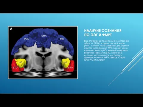 НАЛИЧИЕ СОЗНАНИЯ ПО ЭЭГ И ФМРТ Вид спереди дополнительной моторной