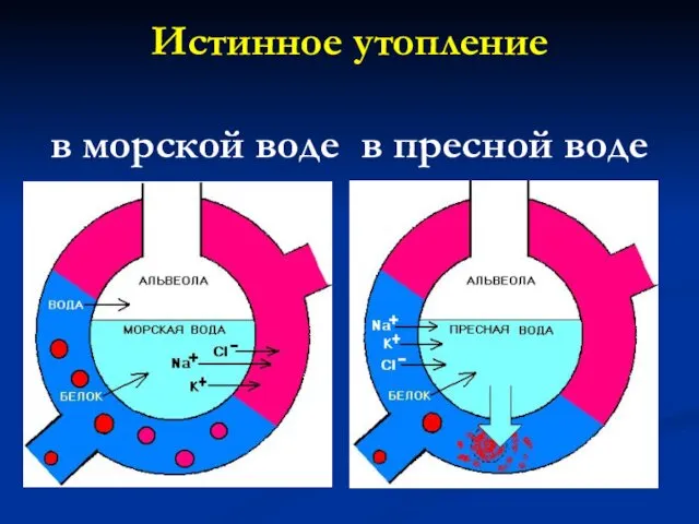 Истинное утопление в морской воде в пресной воде