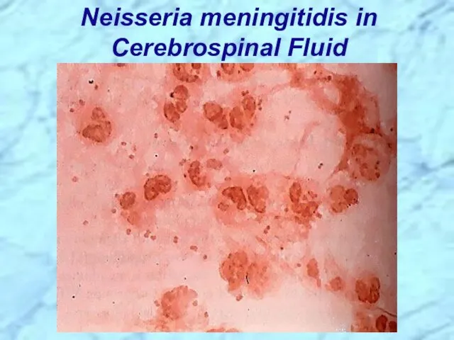 Neisseria meningitidis in Cerebrospinal Fluid