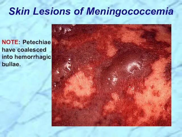 Skin Lesions of Meningococcemia NOTE: Petechiae have coalesced into hemorrhagic bullae.