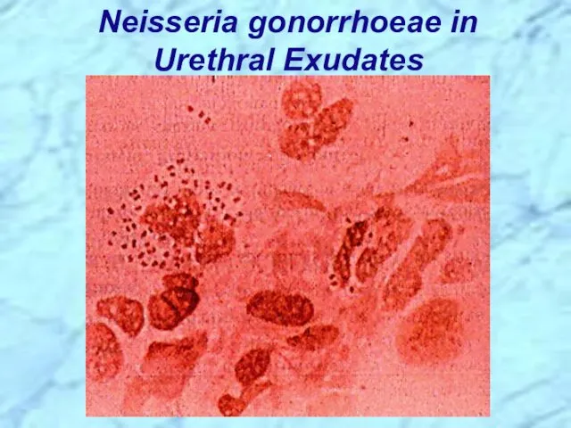 Neisseria gonorrhoeae in Urethral Exudates