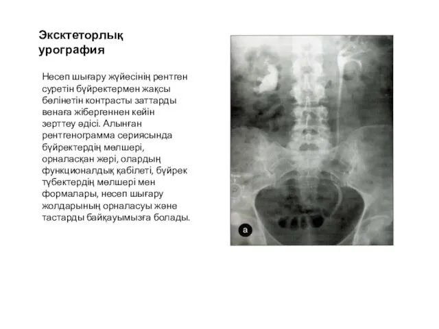 Эксктеторлық урография Несеп шығару жүйесінің рентген суретін бүйректермен жақсы бөлінетін