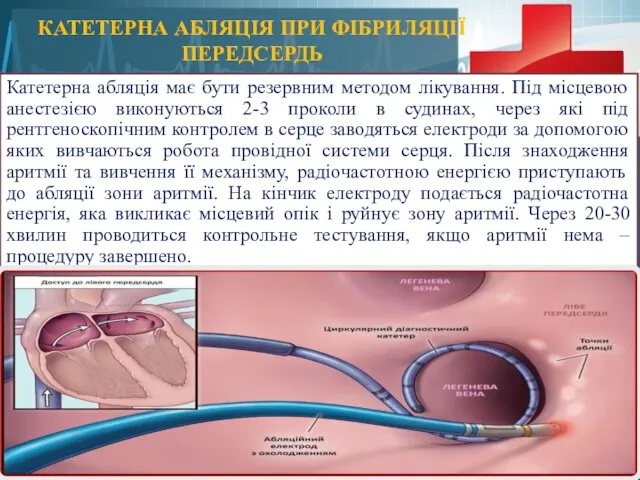 КАТЕТЕРНА АБЛЯЦІЯ ПРИ ФІБРИЛЯЦІЇ ПЕРЕДСЕРДЬ Катетерна абляція має бути резервним методом лікування. Під