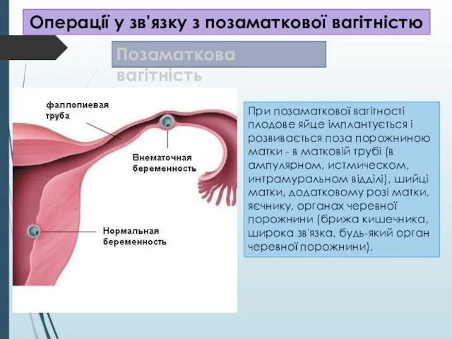 Операції у зв'язку з позаматкової вагітністю Позаматкова вагітність При позаматкової