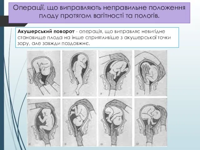 Операції, що виправляють неправильне положення плоду протягом вагітності та пологів.