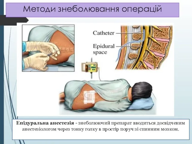 Методи знеболювання операцій Епідуральна анестезія - знеболюючий препарат вводиться досвідченим