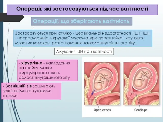 Операції, які застосовуються під час вагітності Операції, що зберігають вагітність