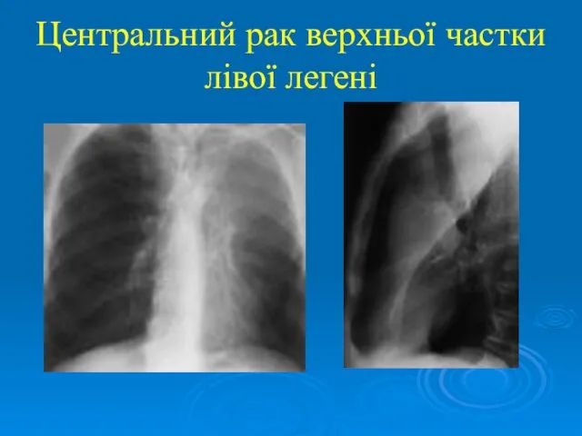 Центральний рак верхньої частки лівої легені