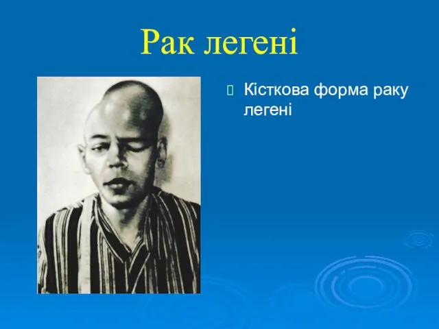 Рак легені Кісткова форма раку легені