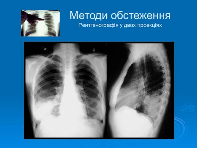 Методи обстеження Рентгенографія у двох проекціях