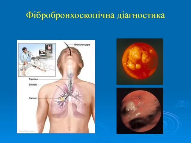 Фібробронхоскопічна діагностика