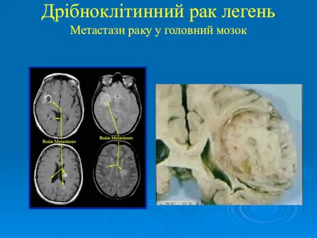 Дрібноклітинний рак легень Метастази раку у головний мозок