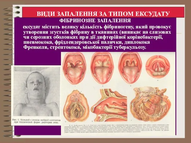 ФІБРИНОЗНЕ ЗАПАЛЕННЯ ексудат містить велику кількість фібриногену, який провокує утворення