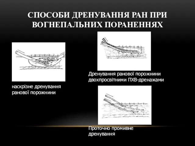 СПОСОБИ ДРЕНУВАННЯ РАН ПРИ ВОГНЕПАЛЬНИХ ПОРАНЕННЯХ Проточно промивне дренування Дренування