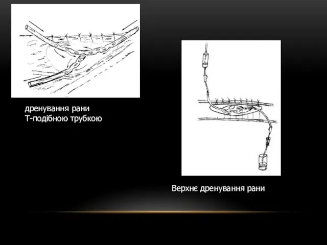 дренування рани Т-подібною трубкою Верхнє дренування рани