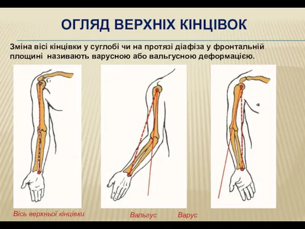 ОГЛЯД ВЕРХНІХ КІНЦІВОК Зміна вісі кінцівки у суглобі чи на