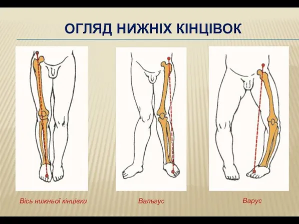 ОГЛЯД НИЖНІХ КІНЦІВОК Вісь нижньої кінцівки Вальгус Варус