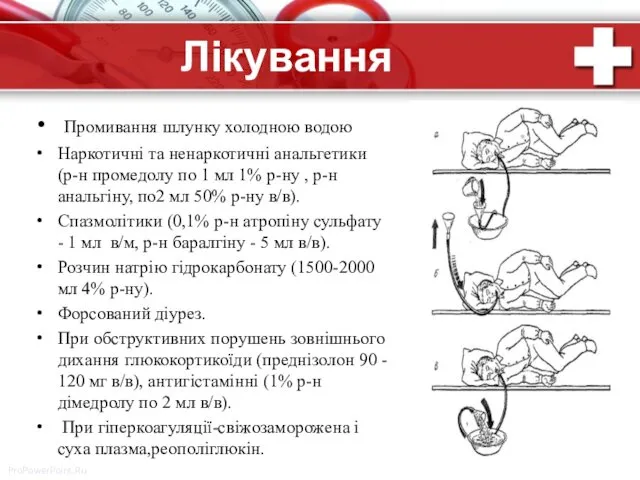 Лікування Промивання шлунку холодною водою Наркотичні та ненаркотичні анальгетики (р-н