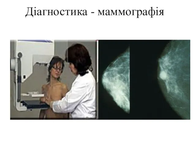 Діагностика - маммографія