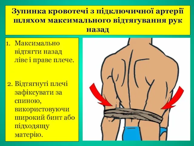 Зупинка кровотечі з підключичної артерії шляхом максимального відтягування рук назад