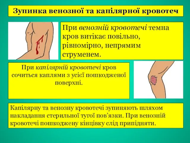 Зупинка венозної та капілярної кровотеч Капілярну та венозну кровотечі зупиняють