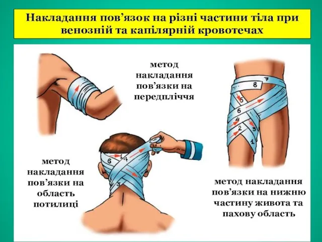 Накладання пов’язок на різні частини тіла при венозній та капілярній