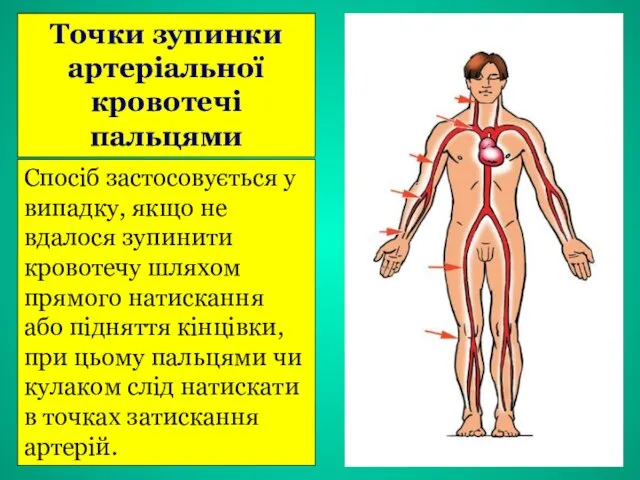 Точки зупинки артеріальної кровотечі пальцями Спосіб застосовується у випадку, якщо