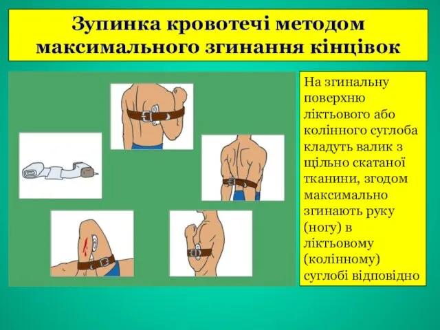 Зупинка кровотечі методом максимального згинання кінцівок На згинальну поверхню ліктьового