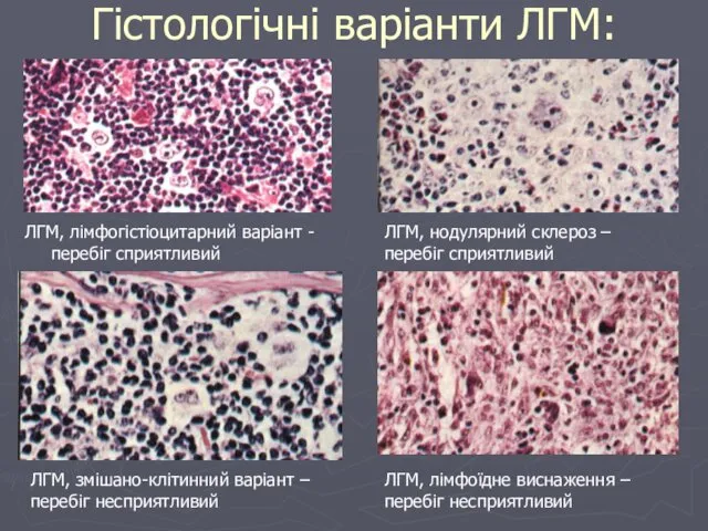 Гістологічні варіанти ЛГМ: ЛГМ, лімфогістіоцитарний варіант - перебіг сприятливий ЛГМ,