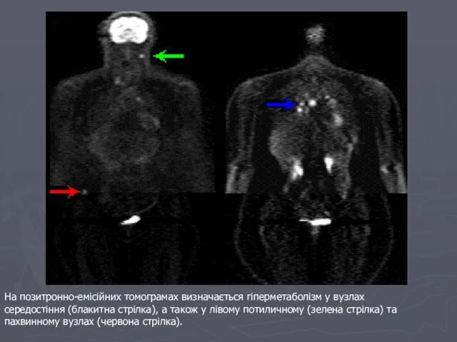 На позитронно-емісійних томограмах визначається гіперметаболізм у вузлах середостіння (блакитна стрілка), а також у