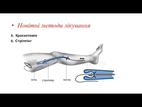 Новітні методи лікування A. Кросектомія B. Стріппінг