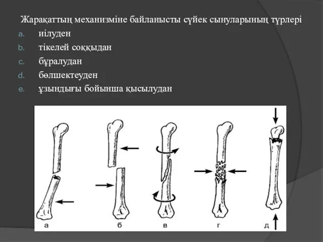 Жарақаттың механизміне байланысты сүйек сынуларының түрлері иілуден тікелей соққыдан бұралудан бөлшектеуден ұзындығы бойынша қысылудан