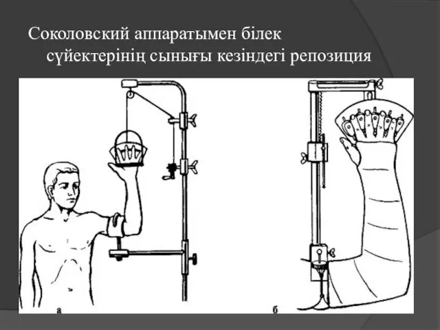 Соколовский аппаратымен білек сүйектерінің сынығы кезіндегі репозиция